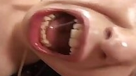 extreme anal prolapse